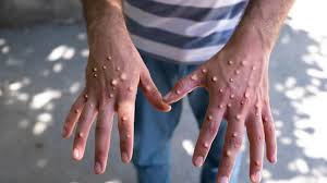 আফ্রিকা ও ইউরোপের পর পাকিস্তানে এমপক্সের সংক্রমণ,আক্রান্ত ৩ জন