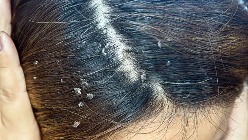 খুশকি থেকে মুক্তির উপায়